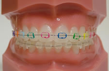 東京都の子どもの歯並び（小児矯正）専門医院、キッズデンタルの永久歯の叢生・位置異常（2期治療）の矯正治療