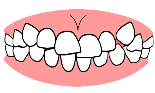 東京都の子どもの歯並び（小児矯正）歯科専門医院、キッズデンタルで叢生（乱ぐい歯・八重歯）の治療