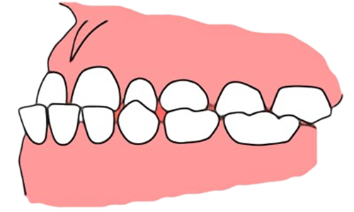 東京都の子どもの歯並び（小児矯正）歯科専門医院、キッズデンタルで反対咬合（受け口）の治療