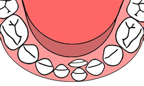 東京都の子どもの歯並び（小児矯正）専門医院、キッズデンタルの下の前歯の重複萌出の矯正治療