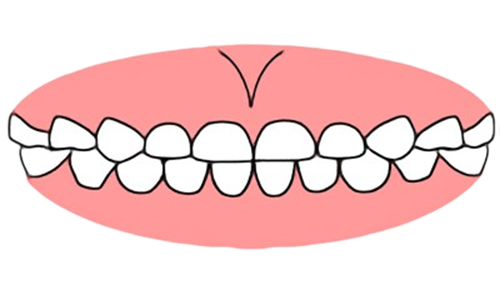 東京都の子どもの歯並び（小児矯正）歯科専門医院、キッズデンタルで緊密歯列の治療