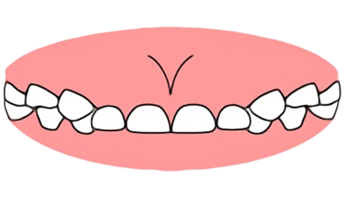 東京都の子どもの歯並び（小児矯正）歯科専門医院、キッズデンタルで過蓋咬合の治療