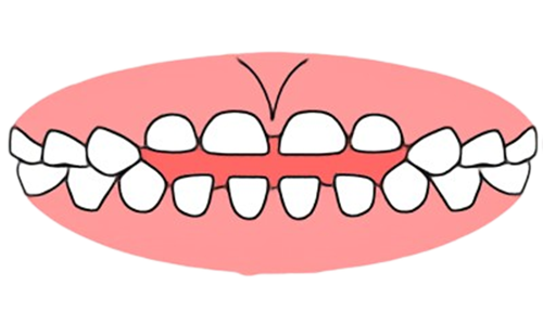 東京都の子どもの歯並び（小児矯正）歯科専門医院、キッズデンタルで開咬（オープンバイト）の治療