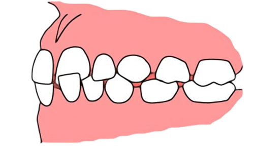 東京都の子どもの歯並び（小児矯正）歯科専門医院、キッズデンタルで前歯の交叉咬合の治療