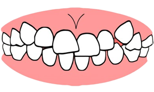 東京都の子どもの歯並び（小児矯正）歯科専門医院、キッズデンタルで永久歯の叢生・位置異常の治療