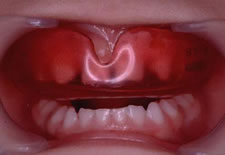 東京都の子どもの歯並び（小児矯正）専門医院、キッズデンタルの反対咬合（受け口）の矯正治療